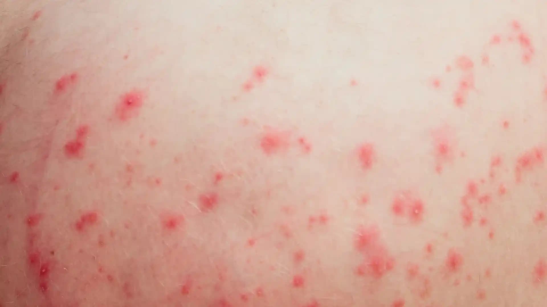 Vücutta Kırmızı Noktalar Neden Oluşur ve Tedavi Yöntemleri Nelerdir