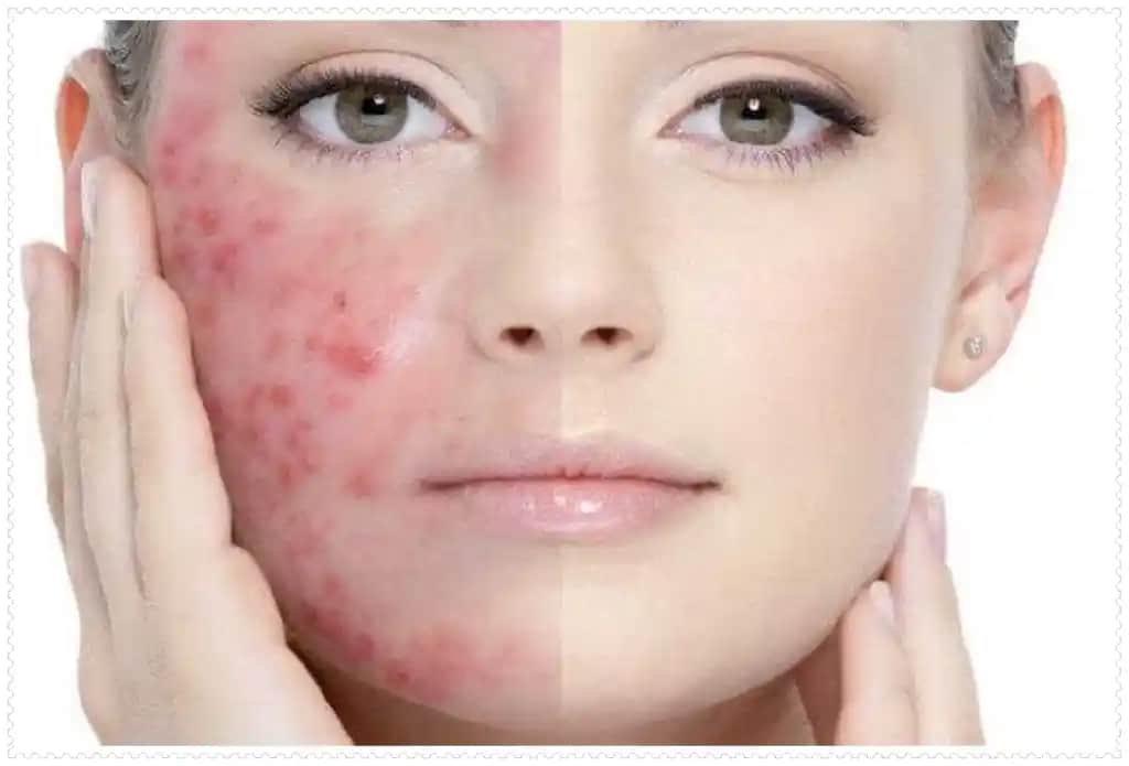 Vücutta Küçük Sivilceler: Nedenleri ve Etkili Bakım Yöntemleri Hakkında Kapsamlı Rehber