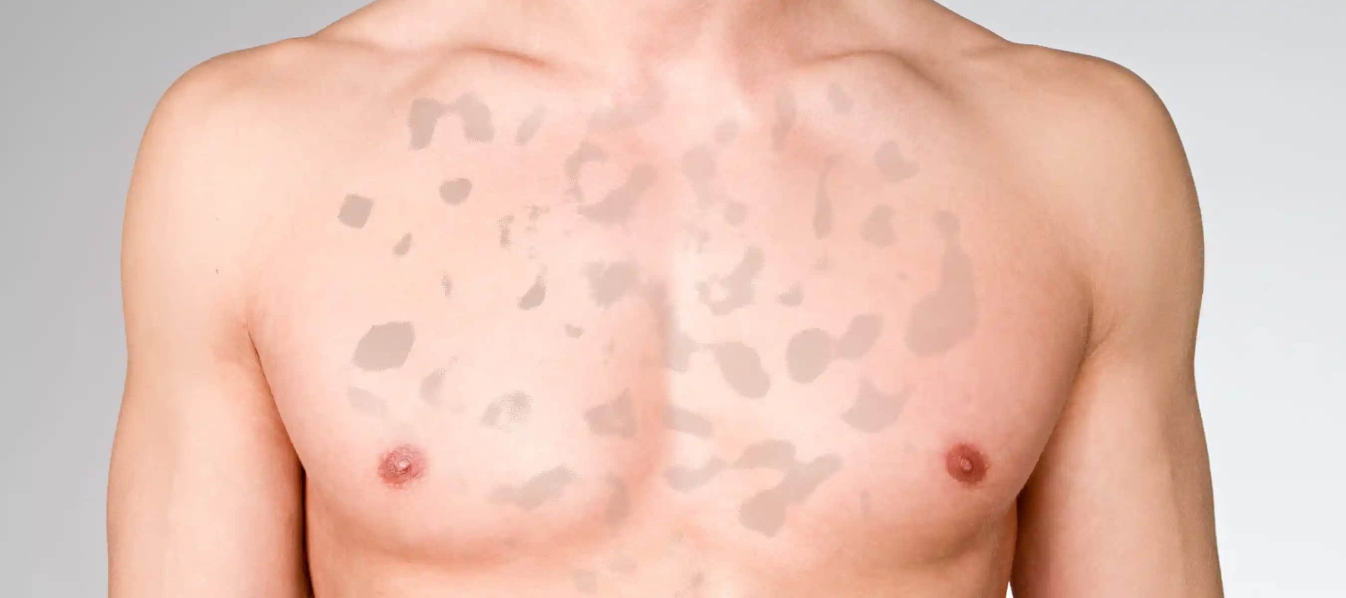 Vücutta Lekelerin Nedenleri ve Etkili Çözüm Yöntemleri Hakkında Kapsamlı Rehber