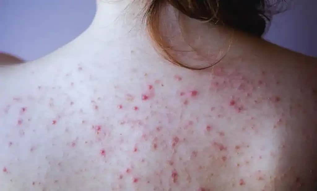 Vücutta Nokta Nokta Kabarma Nedenleri ve Etkili Çözüm Yolları