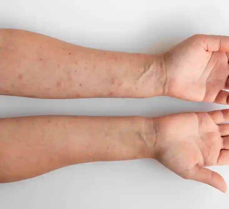 Vücutta Sedef Hastalığı ve Kozmetik Yaklaşımlar: Etkili Bakım ve Ürün Seçimi Rehberi