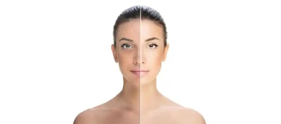 Vücutta Sivilceler Nasıl Giderilir: Etkili ve Güvenilir Yöntemler