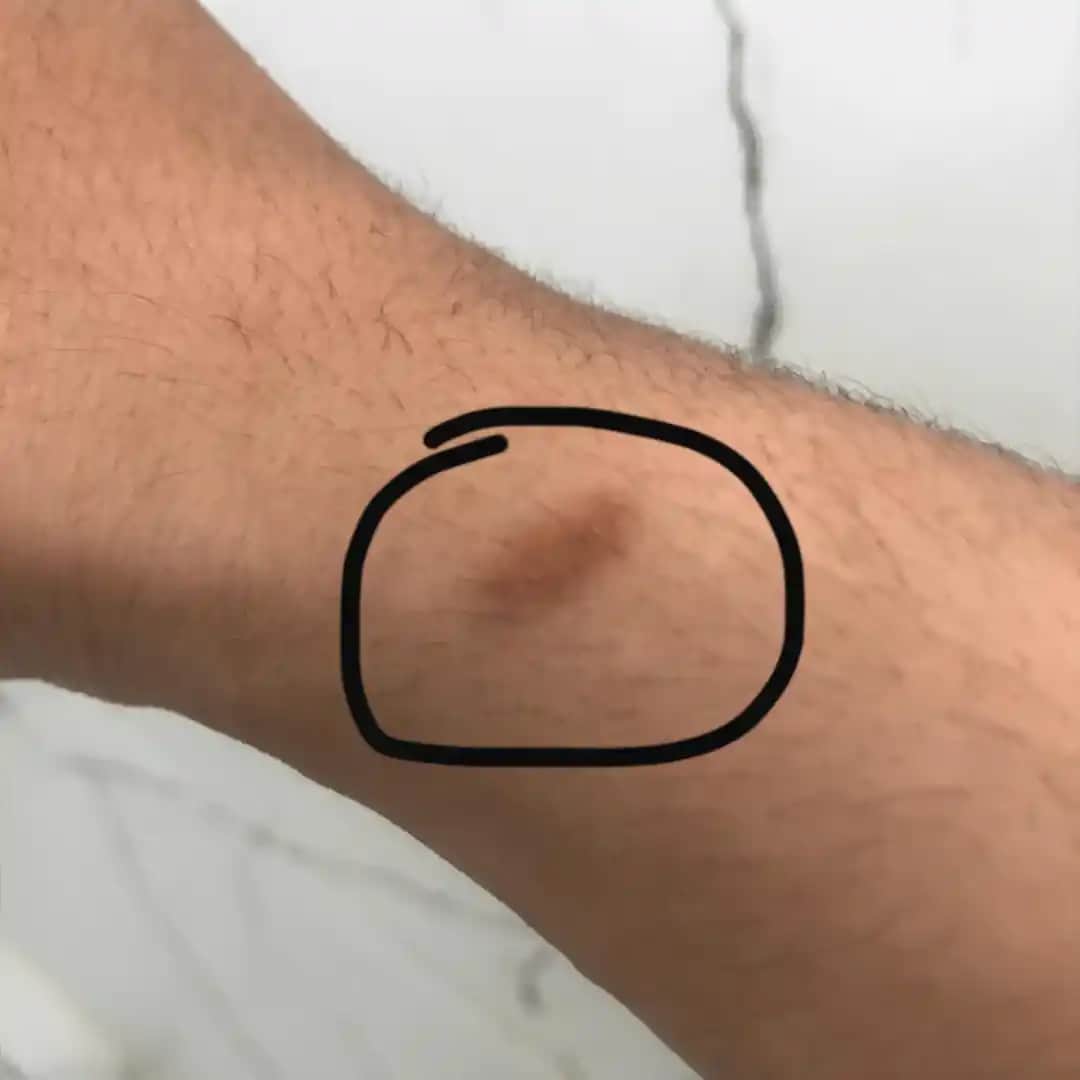 Vücutta Yaraların Nedenleri ve Kozmetik Bakım Yöntemleri Hakkında Kapsamlı Bilgi