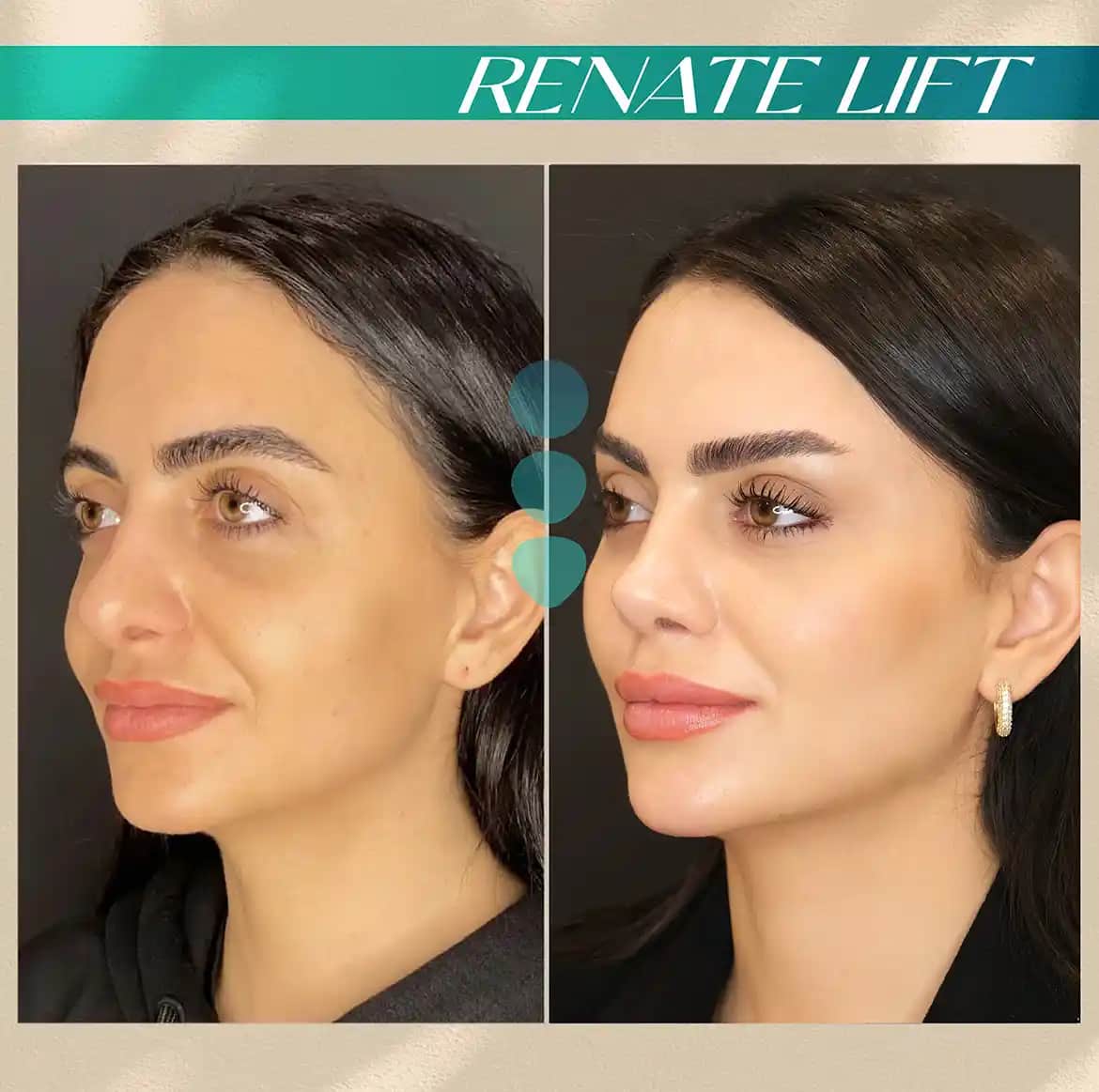 Yanak Dolgunlaştırma Yöntemleri ve Estetik Uygulamalar Hakkında Bilgiler