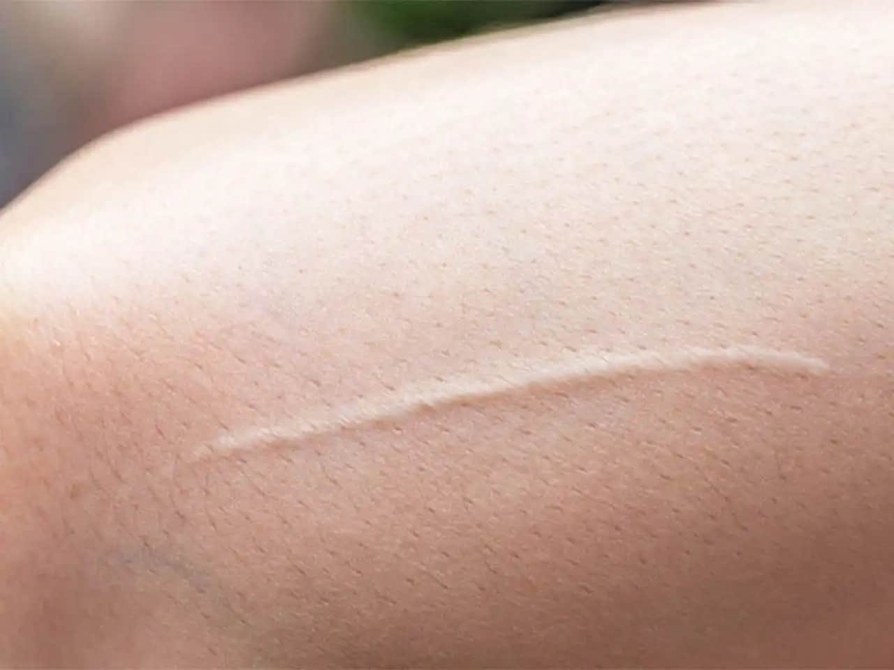 Yara İzleri Nasıl Geçer Estetik ve Kozmetik Yaklaşımlarla Cilt İyileştirme