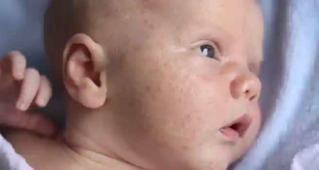 Yeni Doğan Bebeklerin Yüz Sivilceleri: Nedenleri, Bakım Yöntemleri ve Tedavi Seçenekleri