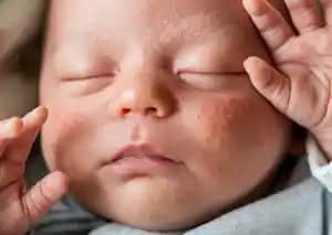 Yenidoğan Aknesi Nedir, Belirtileri ve Bebekler İçin Uygun Cilt Bakımı Yöntemleri