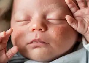 Yenidoğan Aknesi Nedir, Belirtileri ve Bebekler İçin Uygun Cilt Bakımı Yöntemleri