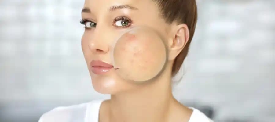 Yenidoğan Bebeklerde Yüzdeki Sivilceler: Nedenleri, Belirtileri ve Doğal Çözüm Yöntemleri