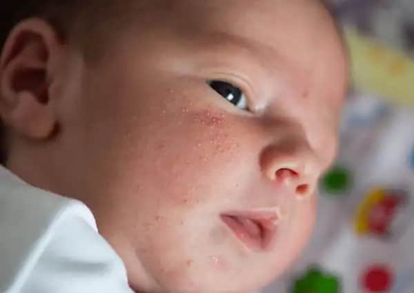 Yenidoğan Sivilcesi Nedenleri ve Doğru Bakım Yöntemleri Hakkında Kapsamlı Bilgi