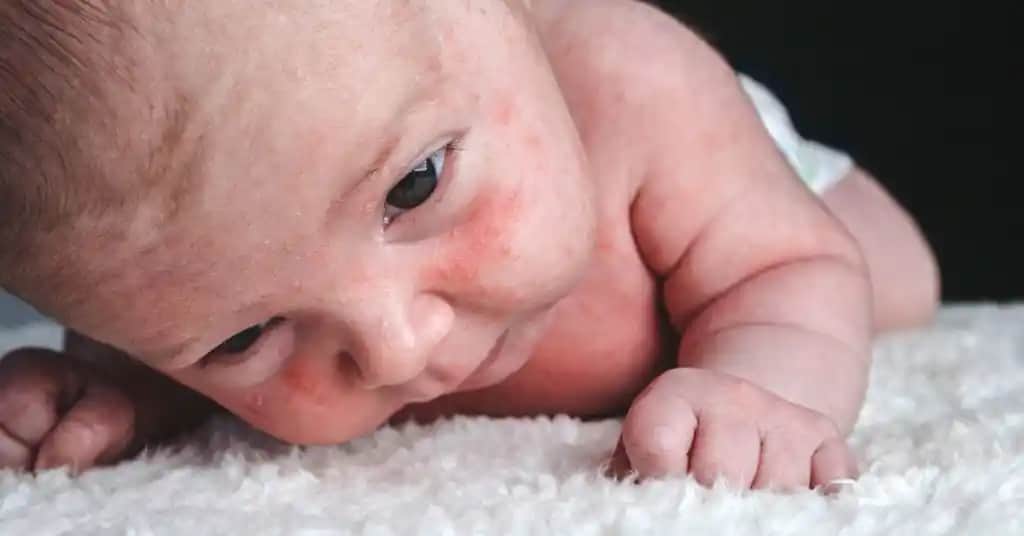 Yenidoğan Yüzündeki Beyaz Noktalar: Nedenleri, Endişe Edilmeli mi ve Nasıl Müdahale Edilmeli?