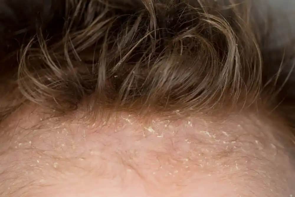 Yetişkinlerde Saçta Konak Nedenleri, Belirtileri ve Etkili Çözüm Yolları