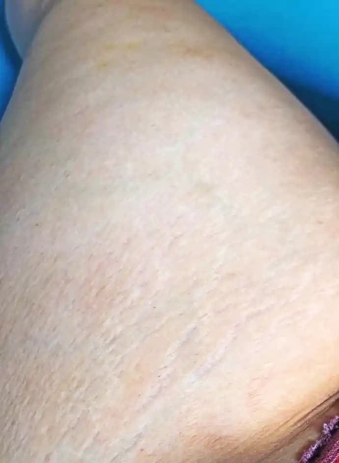 Yırtıklar Nasıl Geçer: Doğal ve Profesyonel Çözüm Yöntemleri