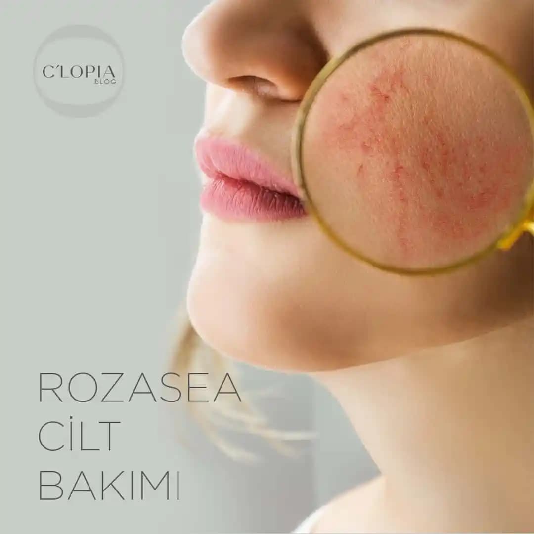 Yoğurt Rozasea: Doğal Kozmetik Çözümler ve Cilt Sağlığına Katkıları