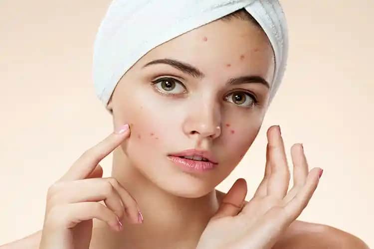 Yulaf ve Sivilce İlişkisi: Doğal Güzellik Kaynağı mı ve Cilt Sağlığı Üzerindeki Etkileri