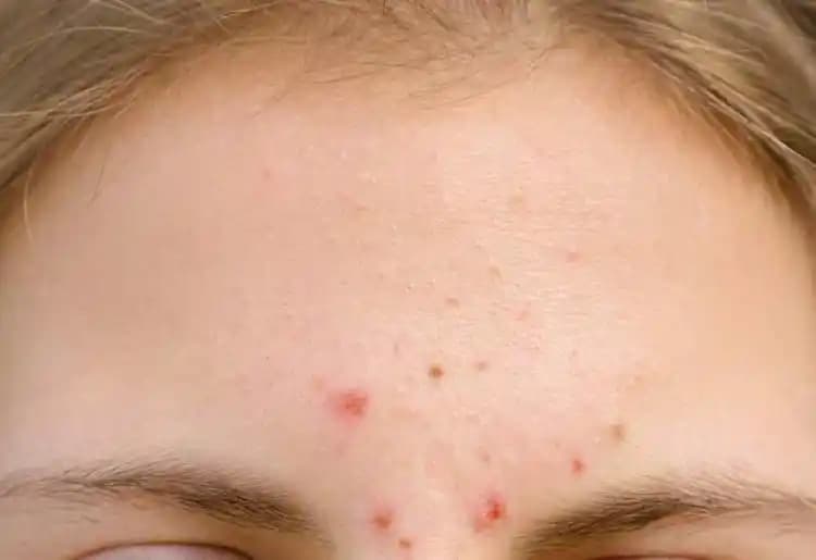 Yüz Kenarlarında Çıkan Sivilcelerin Nedenleri ve Etkili Çözüm Yolları