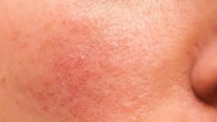 Yüz Kızarıklığı Nasıl Geçer: Etkili Çözüm Yöntemleri ve Günlük Bakım Tavsiyeleri