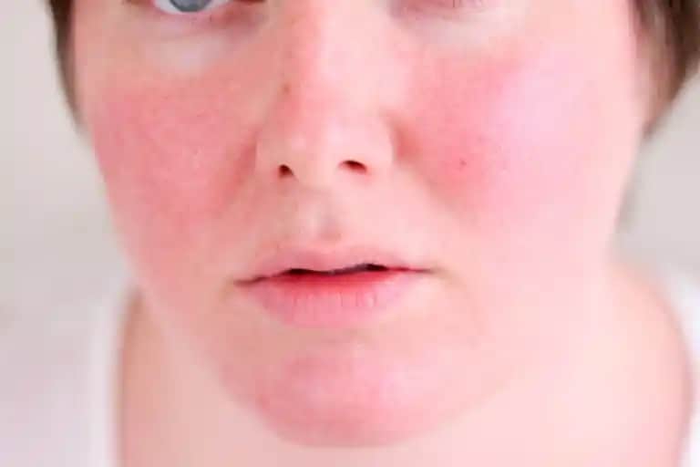 Yüzde Alerji Nedenleri ve Korunma Yöntemleri Hakkında Kapsamlı Rehber