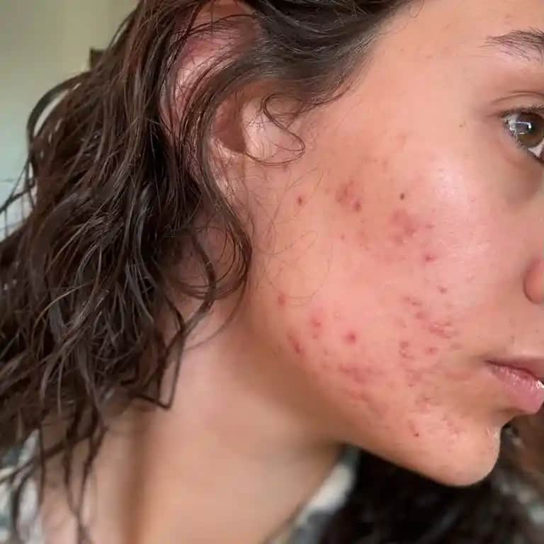 Yüzde Alerji ve Sivilce Arasındaki Bağlantı: Belirtiler, Nedenler ve Çözüm Yöntemleri