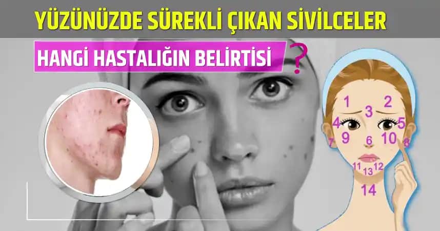 Yüzde Aniden Çıkan Sivilceler İçin Etkili Müdahale ve Bakım Yöntemleri
