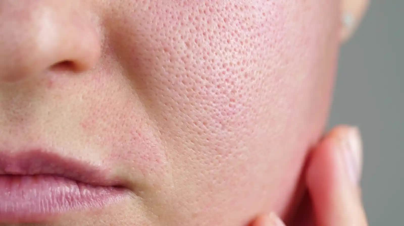 Yüzde Aşırı Yağlanma Sorunu ve Etkili Kontrol Yöntemleri Hakkında Kapsamlı Rehber