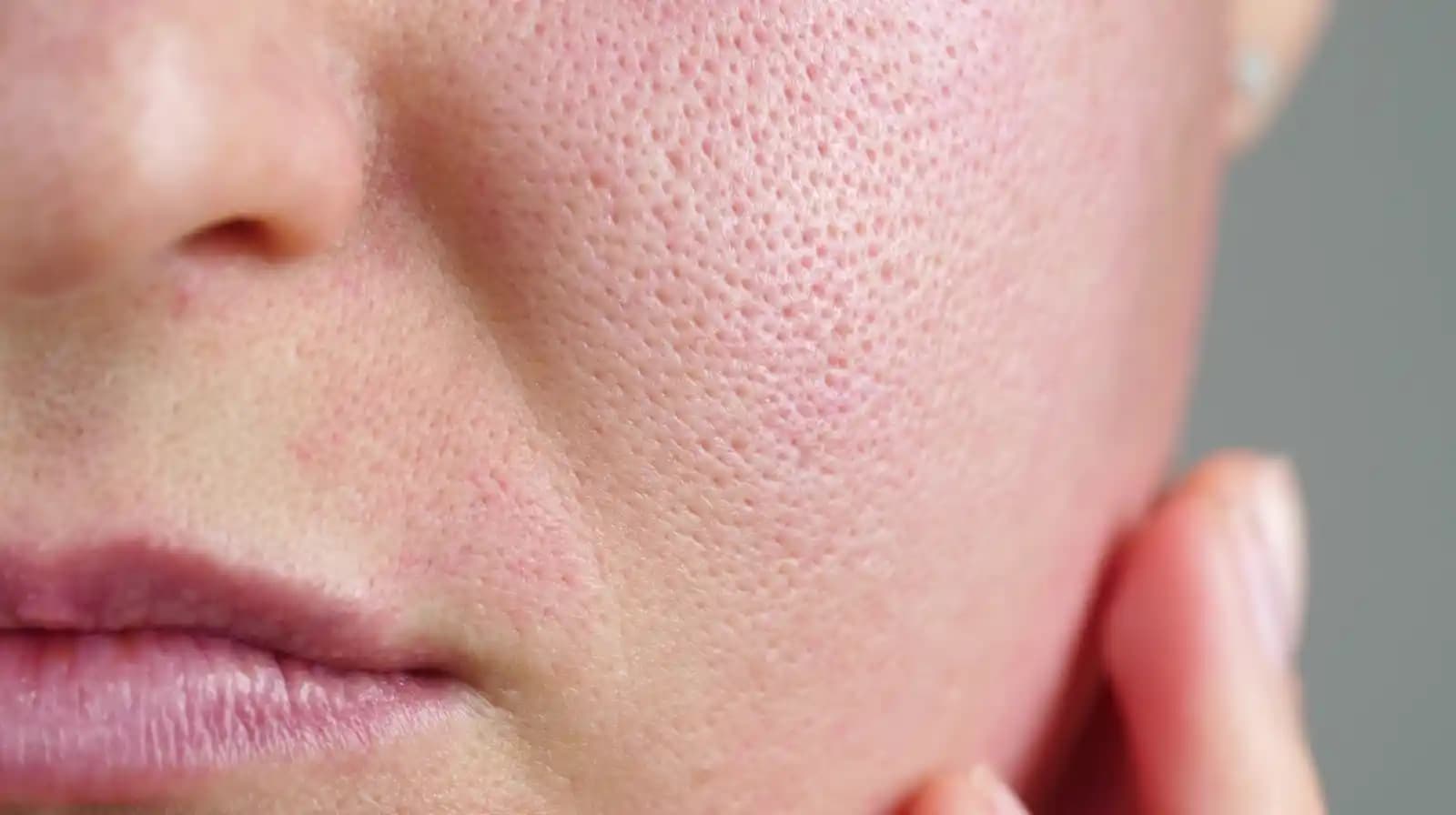 Yüzde Aşırı Yağlanma Sorunu ve Etkili Kontrol Yöntemleri Hakkında Kapsamlı Rehber