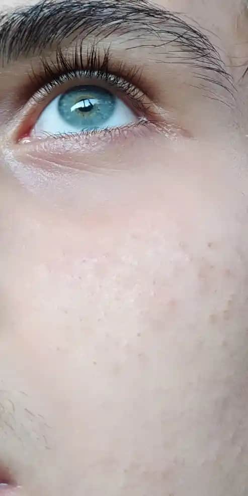 Yüzde Birden Sivilcelenme: Nedenleri ve Doğru Kozmetik Yaklaşımlar