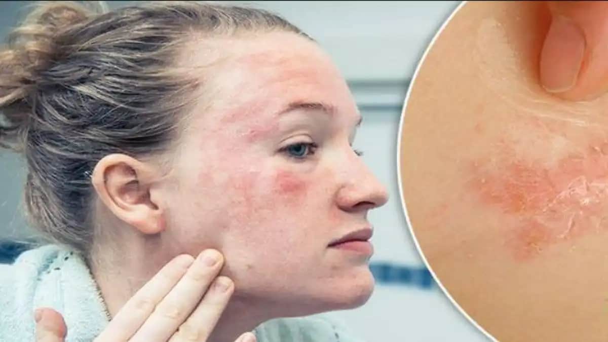 Yüzde Çıkan Egzama Nedenleri Belirtileri ve Etkili Doğal Çözüm Yöntemleri