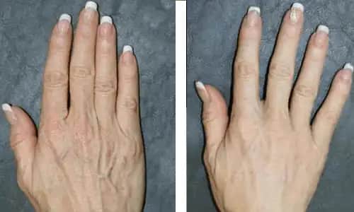 Yüzde Damar Genişlemesi ve Kozmetik Etkileri: Nedenleri ve Tedavi Yöntemleri