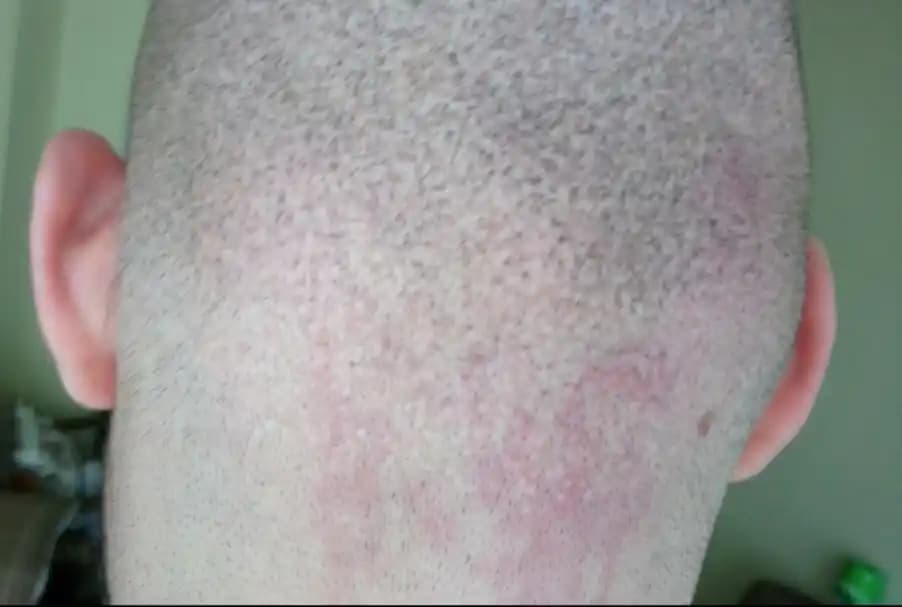 Yüzde Geçmeyen Kızarıklıklar ve Cilt Sağlığında Etkili Çözüm Yöntemleri