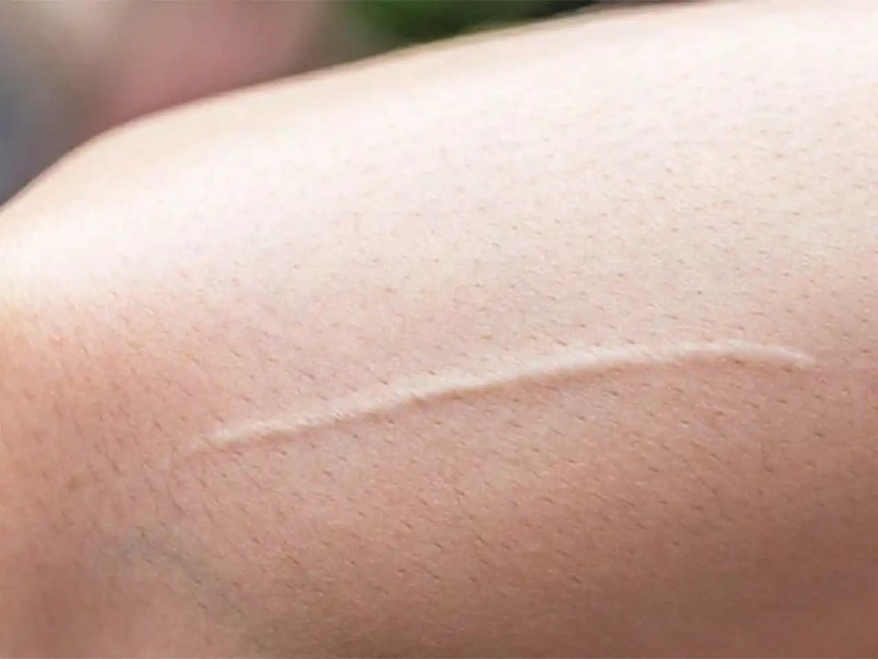 Yüzde Kalıcı Yara İzleri Oluşmaması İçin Etkili Yöntemler ve Önlemler