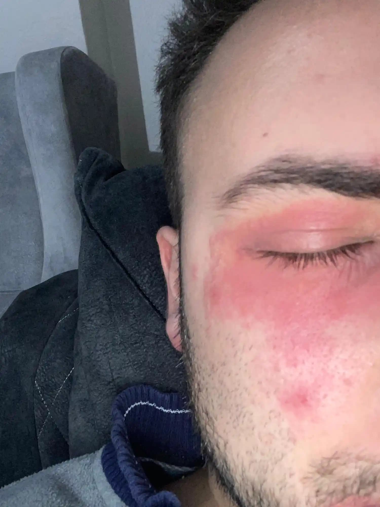 Yüzde Kaşıntı ve Yanma Sorunları: Kozmetik Seçimi ve Cilt Bakım İpuçları