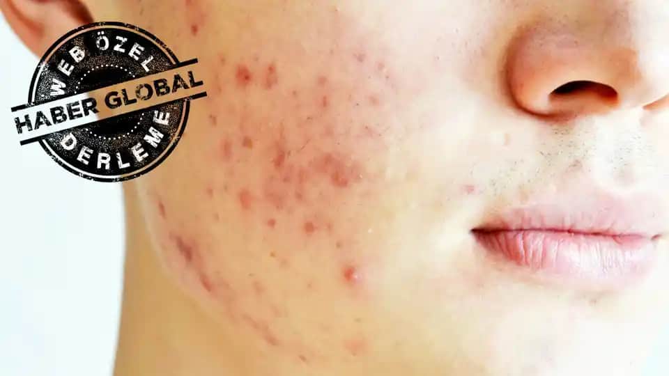 Yüzde Kaşıntılı Sivilce Nedenleri ve Güzellik Bakımında Dikkat Edilmesi Gerekenler
