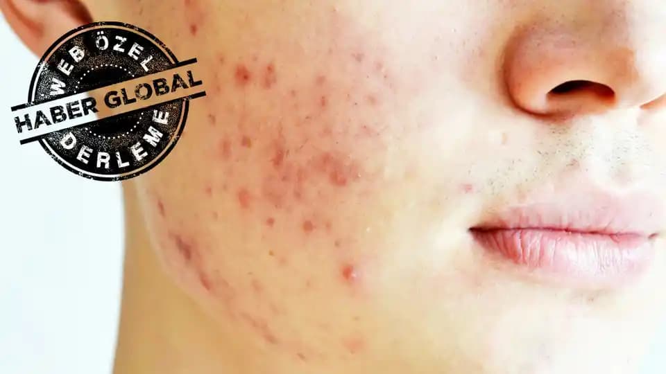 Yüzde Kaşıntılı Sivilce Nedenleri ve Güzellik Bakımında Dikkat Edilmesi Gerekenler