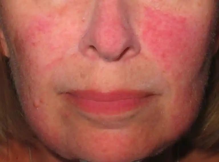 Yüzde Kırmızı Leke Nedenleri, Tedavi Seçenekleri ve Günlük Bakım İpuçları