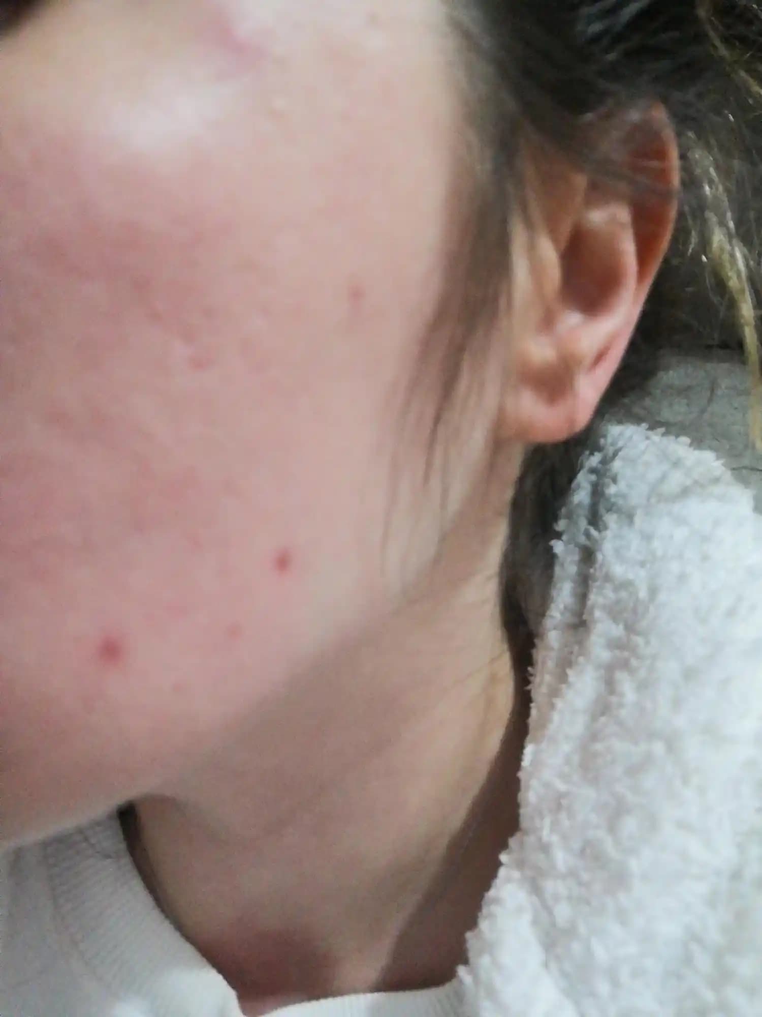 Yüzde Kırmızı Nokta Çıkması Nedenleri ve Tedavi Yöntemleri Hakkında Bilgiler