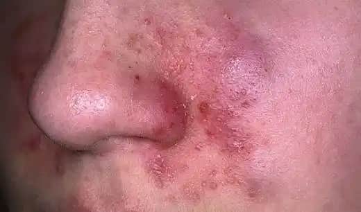 Yüzde Kızarıklık ve Kuruluk Sorunlarına Karşı Etkili Cilt Bakım Yöntemleri ve Tavsiyeler