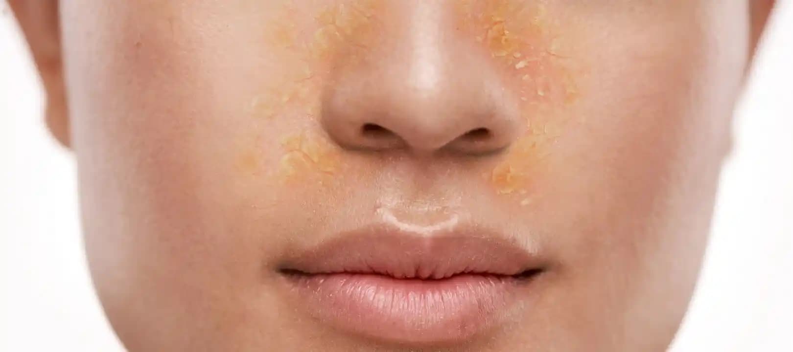 Yüzde Kızarıklık ve Pul Pul Dökülme Sorunlarına Kozmetik Yaklaşımlar ve Çözüm Yöntemleri