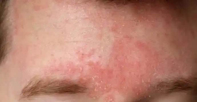 Yüzde Kuru Egzama Nedir, Belirtileri ve Etkili Bakım Yöntemleri