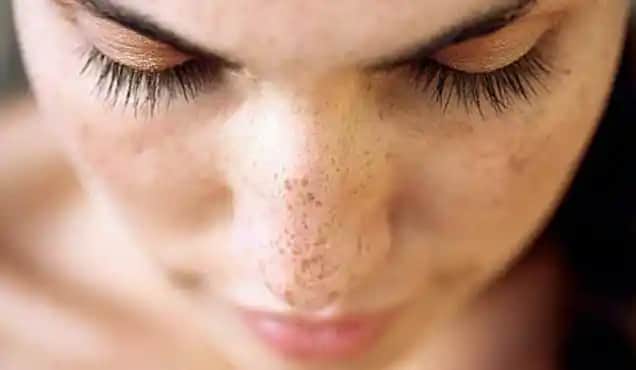 Yüzde Leke Hastalığı Nedenleri Türleri ve Etkili Tedavi Yöntemleri