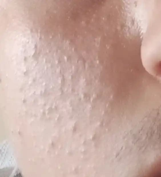 Yüzde Minik Sivilceler: Nedenleri, Çözüm Yolları ve Bakım İpuçları