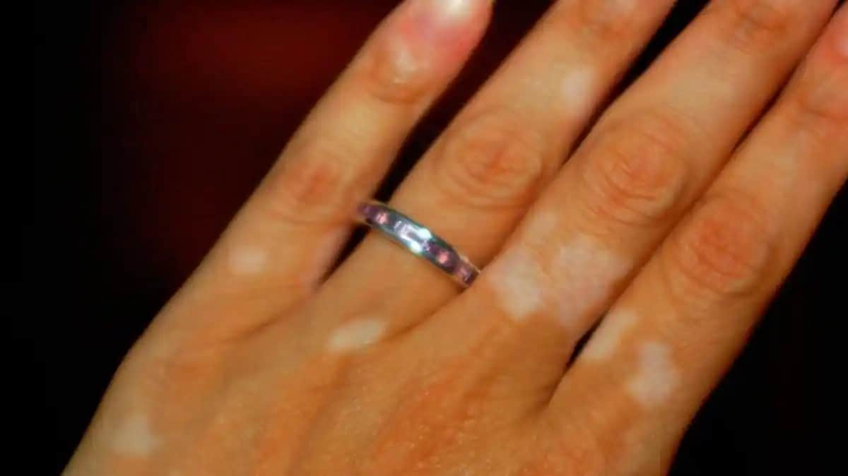 Yüzde Mor Leke Nedenleri, Çözüm Yolları ve Etkili Bakım İpuçları