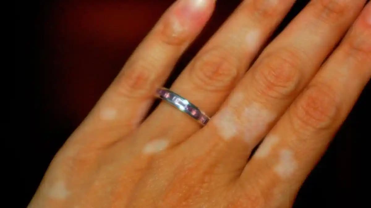 Yüzde Mor Leke Nedenleri, Çözüm Yolları ve Etkili Bakım İpuçları