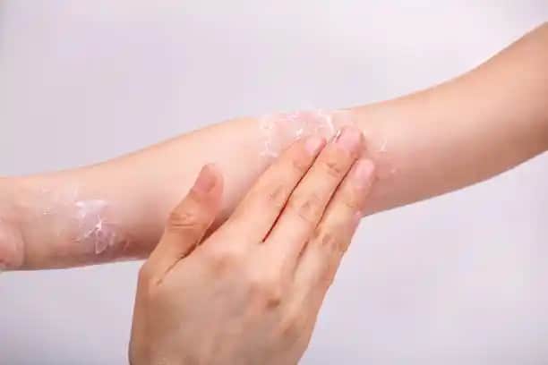 Yüzde Olu Derisi Temizliği ve Doğal Bakım Yöntemleri Hakkında Bilmeniz Gerekenler