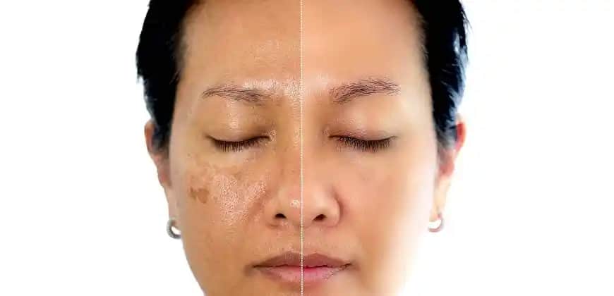 Yüzde Oluşan Lekelerin Nedenleri ve Etkili Tedavi Yöntemleri Hakkında Detaylı Bilgi