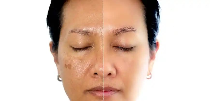 Yüzde Oluşan Lekelerin Nedenleri ve Etkili Tedavi Yöntemleri Hakkında Detaylı Bilgi