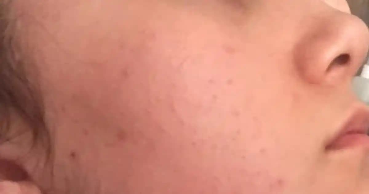 Yüzde Pütür Pütür Alerjisi Nedenleri, Belirtileri ve Çözüm Yolları