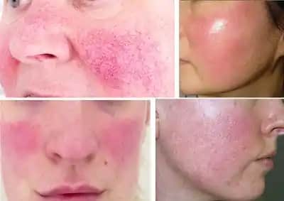 Yüzde Roza Nedir, Belirtileri ve Güncel Tedavi Seçenekleri Hakkında Bilgiler