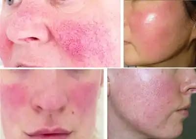 Yüzde Roza Nedir, Belirtileri ve Güncel Tedavi Seçenekleri Hakkında Bilgiler