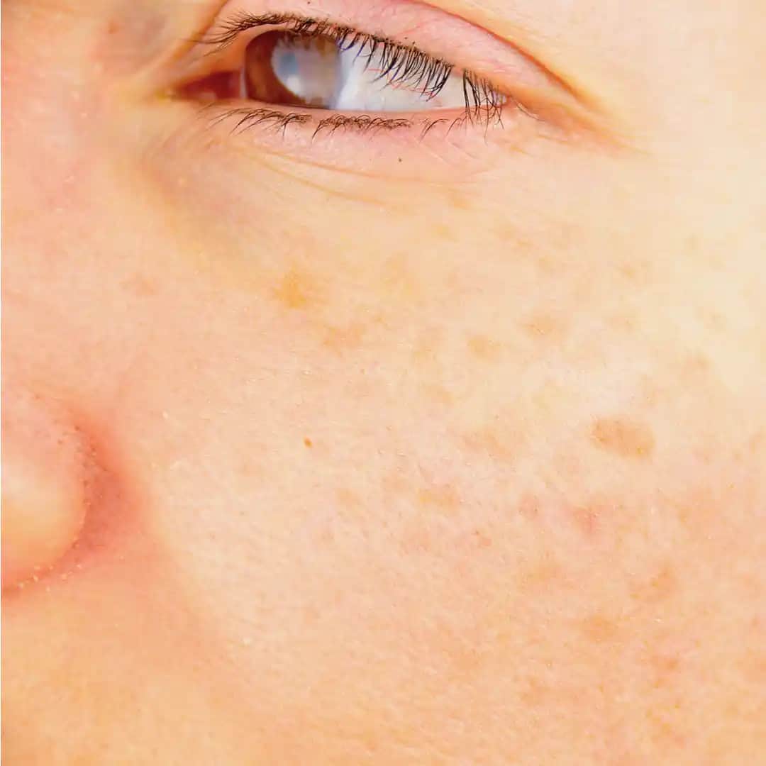 Yüzde Sarı Leke Nedenleri, Giderici Yöntemler ve Güzellik İpuçları